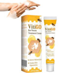 vitigo1_1758004464.jpg